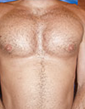 Pec Implants after 887763