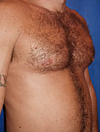Pec Implants 887763