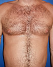Pec Implants before 887763