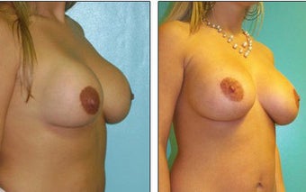 Breast Reconstruction before 1115970