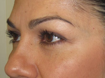 42 year old female with eyelid bags after 811429