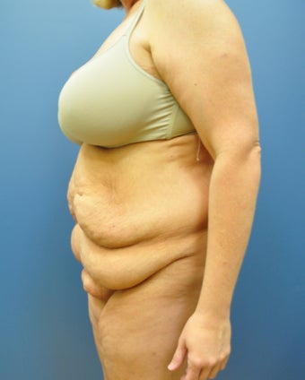 Hourglass Tummy Tuck by Dr. Wilberto Cortes 371929