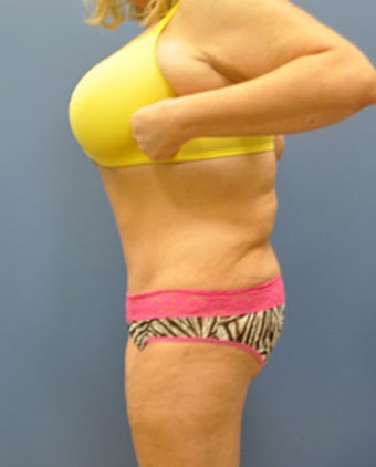 Hourglass Tummy Tuck by Dr. Wilberto Cortes 371929