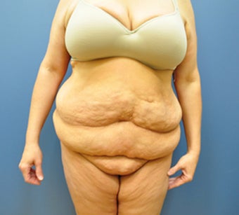 Hourglass Tummy Tuck by Dr. Wilberto Cortes before 371929