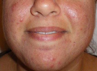 Photodynamic Therapy for Acne before 110229
