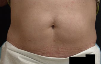 Coolsculpting after 417595