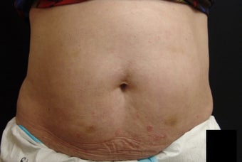 Coolsculpting before 417595