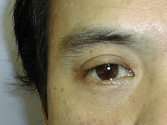 Upper Eyelid Blepharoplasty 1007760