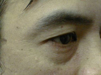 Upper Eyelid Blepharoplasty before 1007760