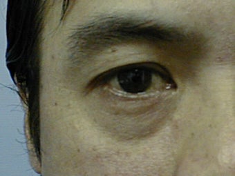 Upper Eyelid Blepharoplasty 1007760