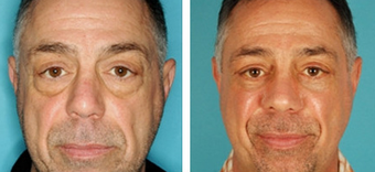 Facelift before 1205208