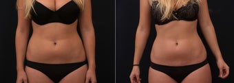 Vanquish Fat Removal Results before 1271989