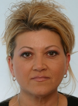 Restylane after 935873