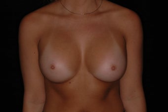 Breast Augmentation after 336247