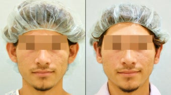 Ear Surgery (Bilateral Otoplasty) before 962946