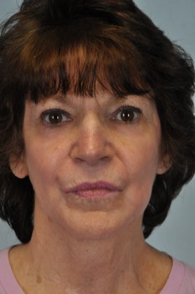 Full Face Hetter Peel after 857666
