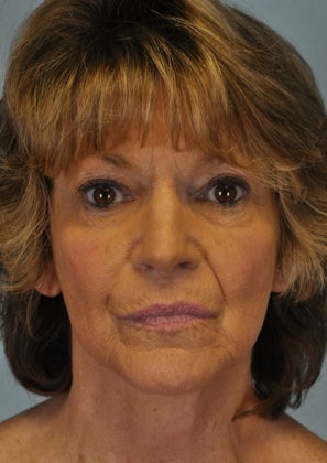 Full Face Hetter Peel before 857666