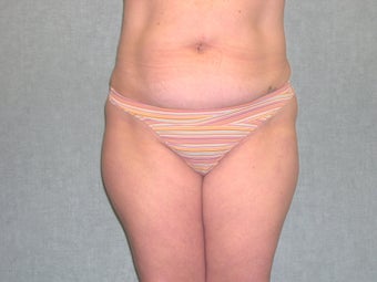 SmartLipo before 607515