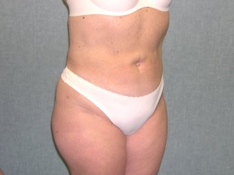 SmartLipo 607515