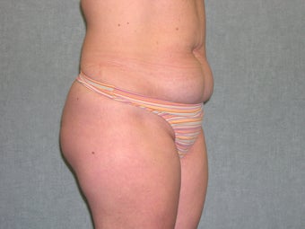 SmartLipo 607515