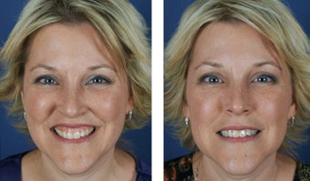 Female Treated For Gummy Smile With Botox before 966253