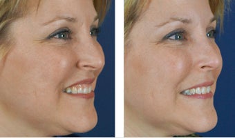 Female Treated For Gummy Smile With Botox 966253