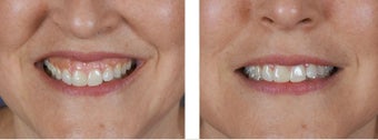 Female Treated For Gummy Smile With Botox after 966253