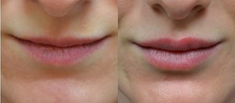 Restylane Filler in Lips before 1306460
