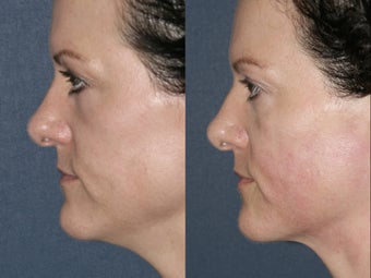 Ultherapy for under chin in 43 year old female before 657823