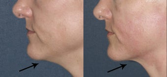 Ultherapy for under chin in 43 year old female after 657823