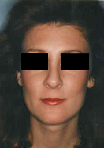 Revision Rhinoplasty after 665085