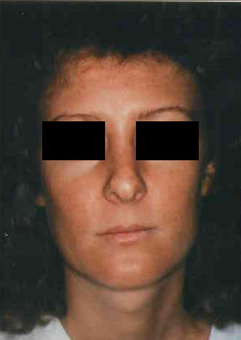 Revision Rhinoplasty before 665085