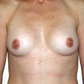 Breast Augmentation after 214434