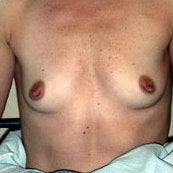 Breast Augmentation before 214434