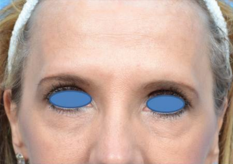 52 Year Old Female after 1270737