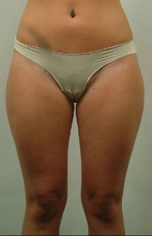 Laser Liposuction of Thighs before 456375