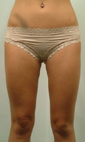 Laser Liposuction of Thighs after 456375