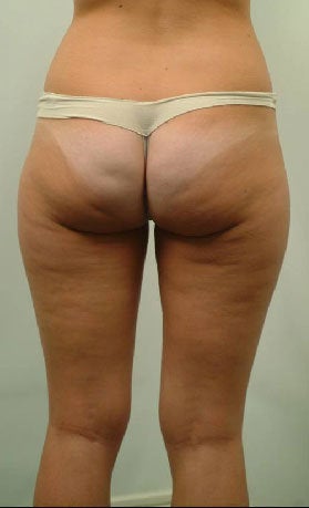 Laser Liposuction of Thighs 456375