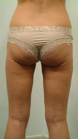 Laser Liposuction of Thighs 456375