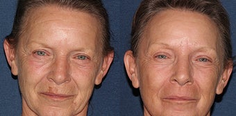 Fraxel Dual Laser Before and After before 1251025