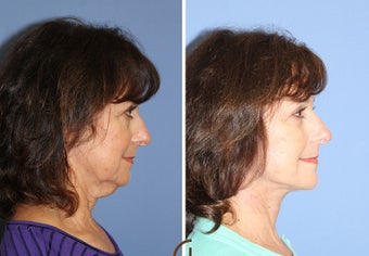 Neck Lift Performed Under Local Anesthesia after 252433