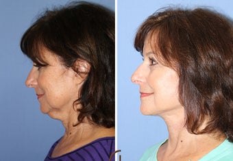 Neck Lift Performed Under Local Anesthesia before 252433