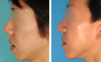 Chin Surgery before 1208037