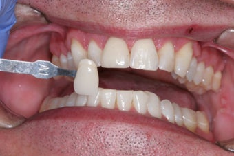 Whitening before 372831