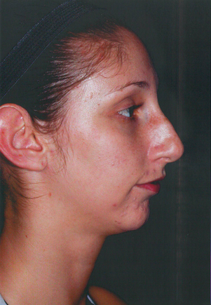 Chin Augmentation before 911589