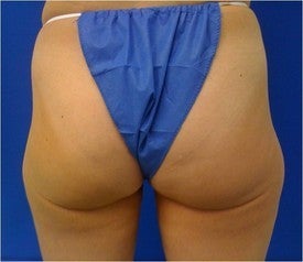 Laser Liposuction before 561229