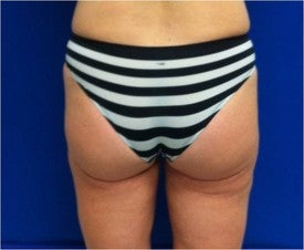 Laser Liposuction after 561229
