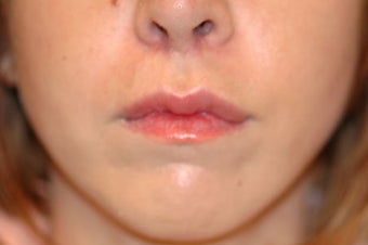Before and After Lip Lift after 65356