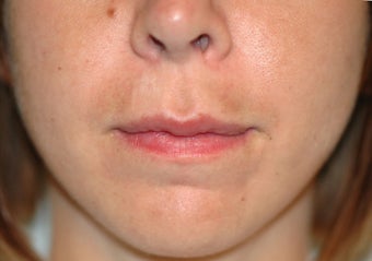 Before and After Lip Lift before 65356