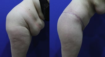 32 Year Old Treated for Abdominal Apron & Sagging Buttocks before 1109109
